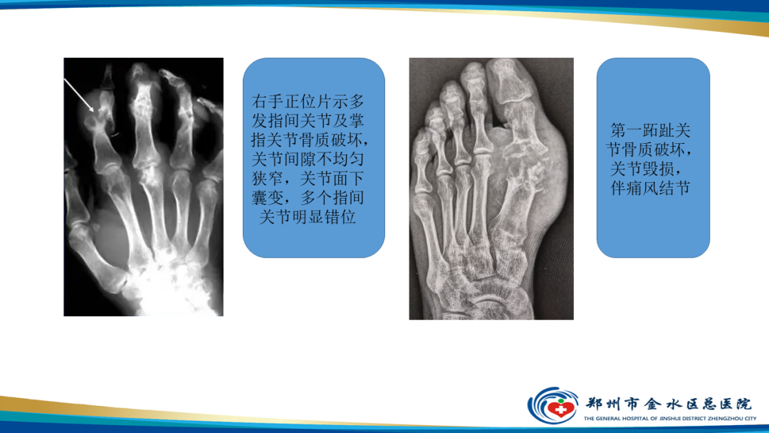影像PPT - 【PPT】痛风的影像诊断及鉴别诊断-21
