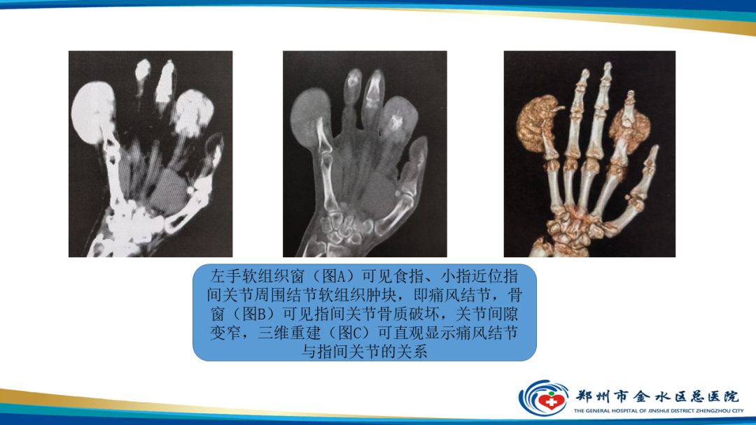 影像PPT - 【PPT】痛风的影像诊断及鉴别诊断-22