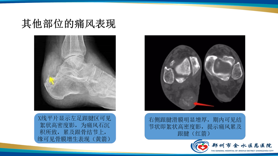 影像PPT - 【PPT】痛风的影像诊断及鉴别诊断-23