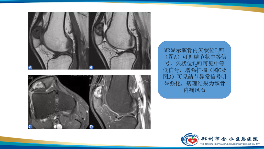 影像PPT - 【PPT】痛风的影像诊断及鉴别诊断-24
