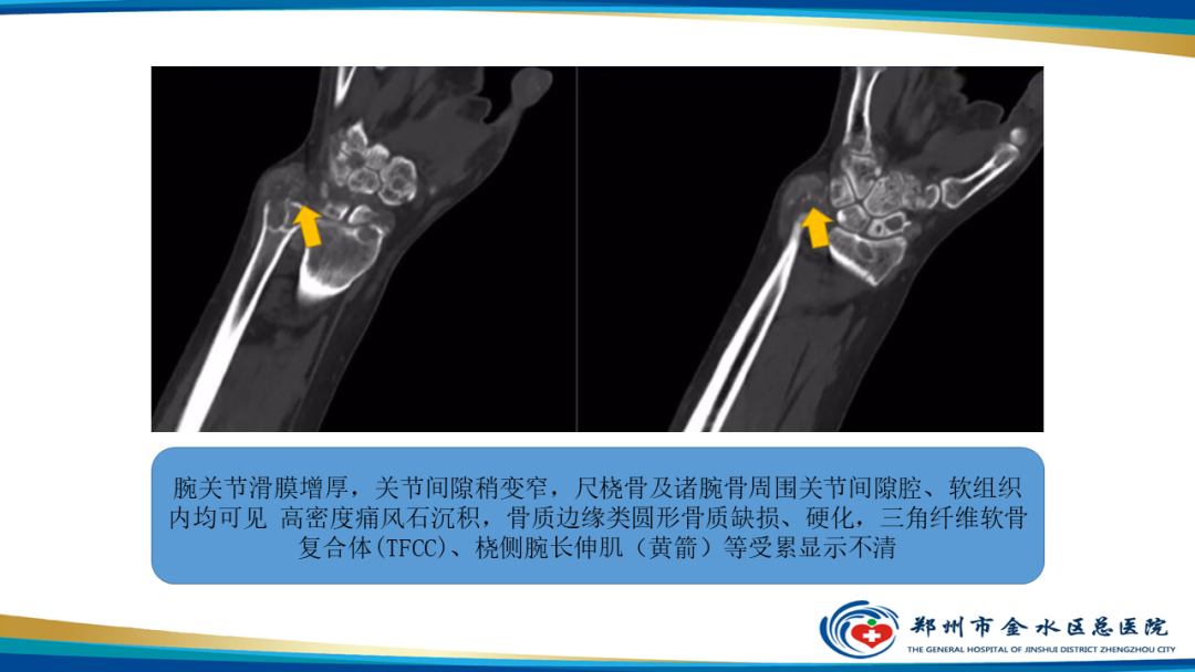 影像PPT - 【PPT】痛风的影像诊断及鉴别诊断-25
