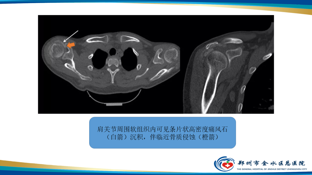影像PPT - 【PPT】痛风的影像诊断及鉴别诊断-26