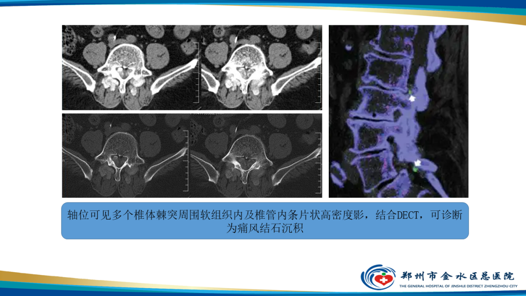 影像PPT - 【PPT】痛风的影像诊断及鉴别诊断-27