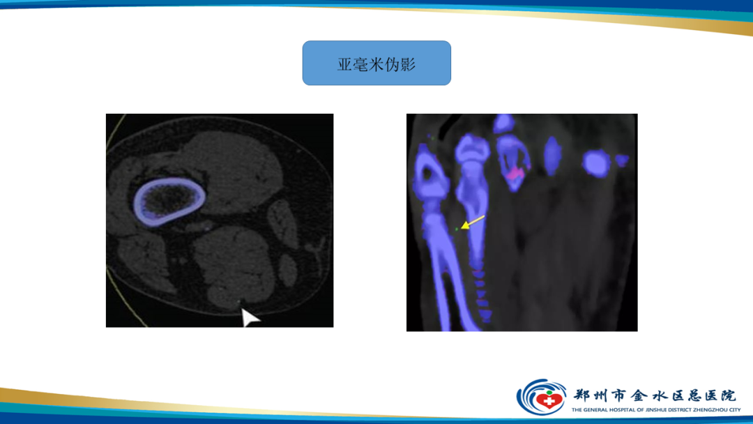 影像PPT - 【PPT】痛风的影像诊断及鉴别诊断-31