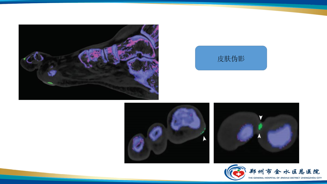 影像PPT - 【PPT】痛风的影像诊断及鉴别诊断-30