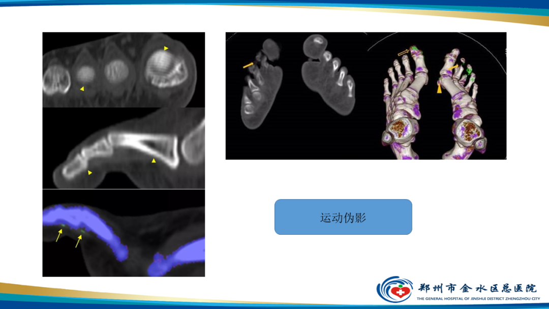 影像PPT - 【PPT】痛风的影像诊断及鉴别诊断-32