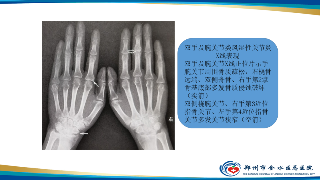 影像PPT - 【PPT】痛风的影像诊断及鉴别诊断-37