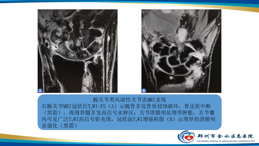 影像PPT - 【PPT】痛风的影像诊断及鉴别诊断-38