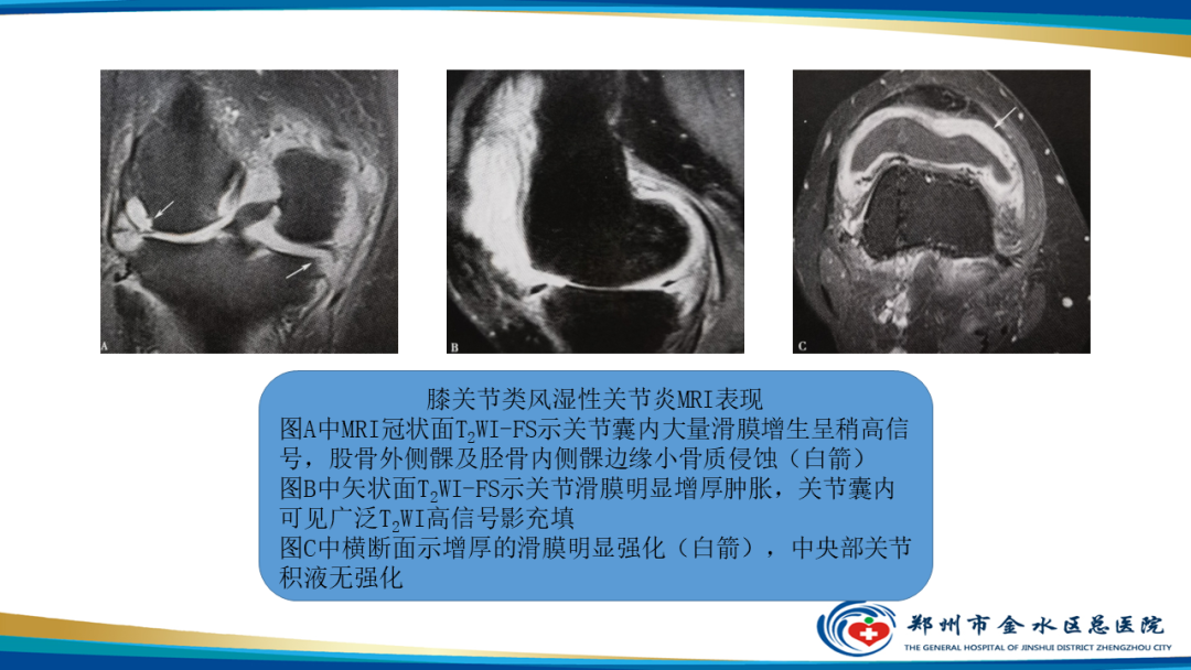 影像PPT - 【PPT】痛风的影像诊断及鉴别诊断-39