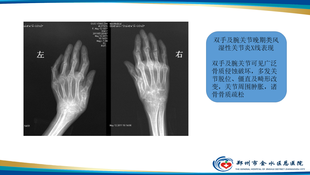 影像PPT - 【PPT】痛风的影像诊断及鉴别诊断-40