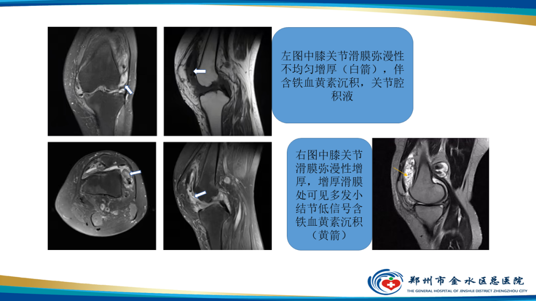 影像PPT - 【PPT】痛风的影像诊断及鉴别诊断-43