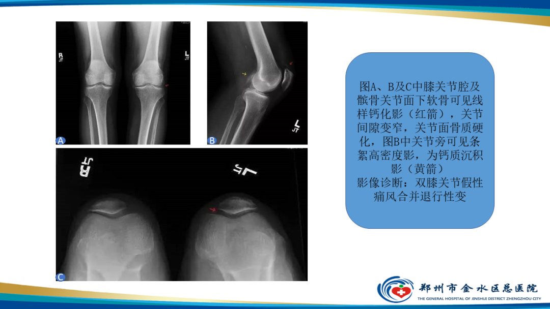 影像PPT - 【PPT】痛风的影像诊断及鉴别诊断-46