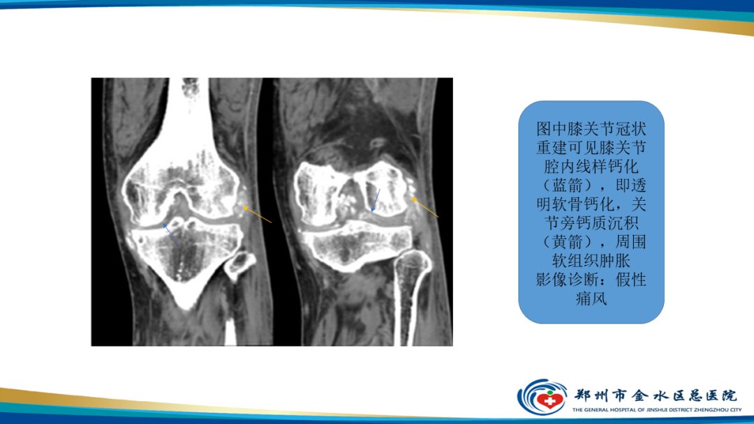 影像PPT - 【PPT】痛风的影像诊断及鉴别诊断-47