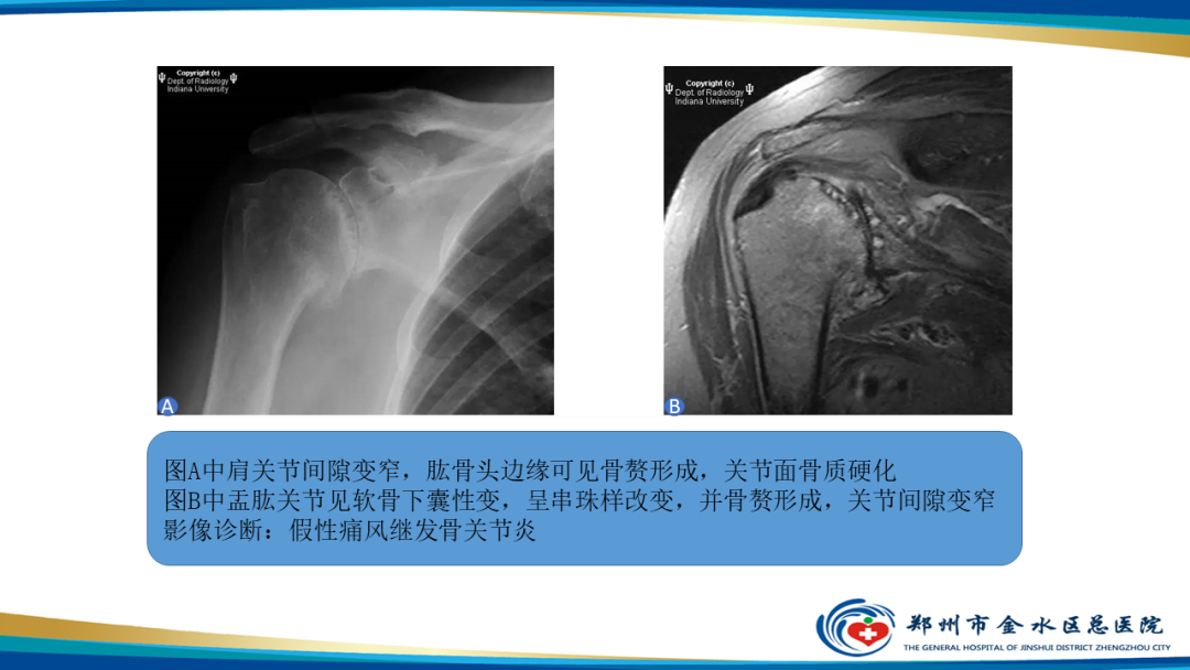 影像PPT - 【PPT】痛风的影像诊断及鉴别诊断-48