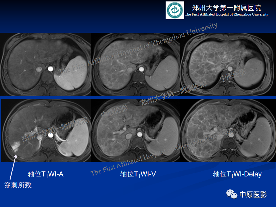 影像PPT - 【病例】肝豆状核变性1例MR影像表现-4