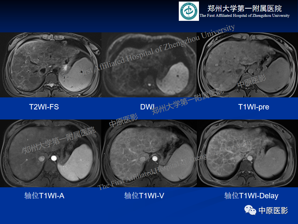 影像PPT - 【病例】肝豆状核变性1例MR影像表现-5