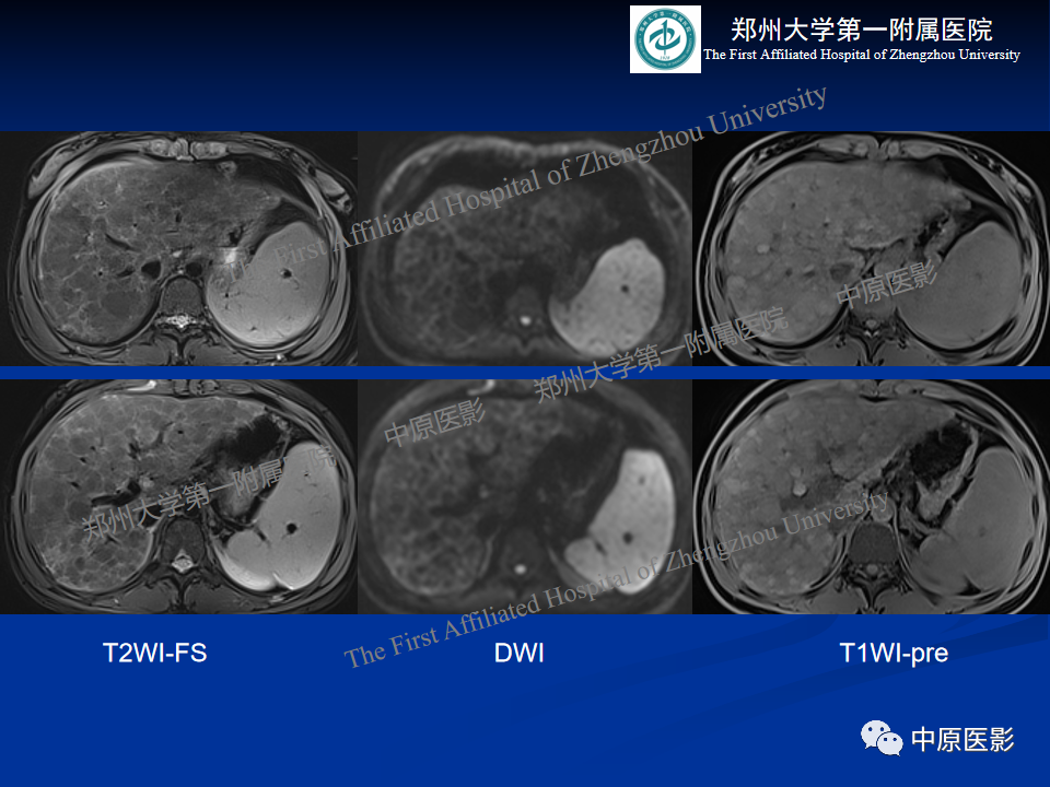 影像PPT - 【病例】肝豆状核变性1例MR影像表现-3
