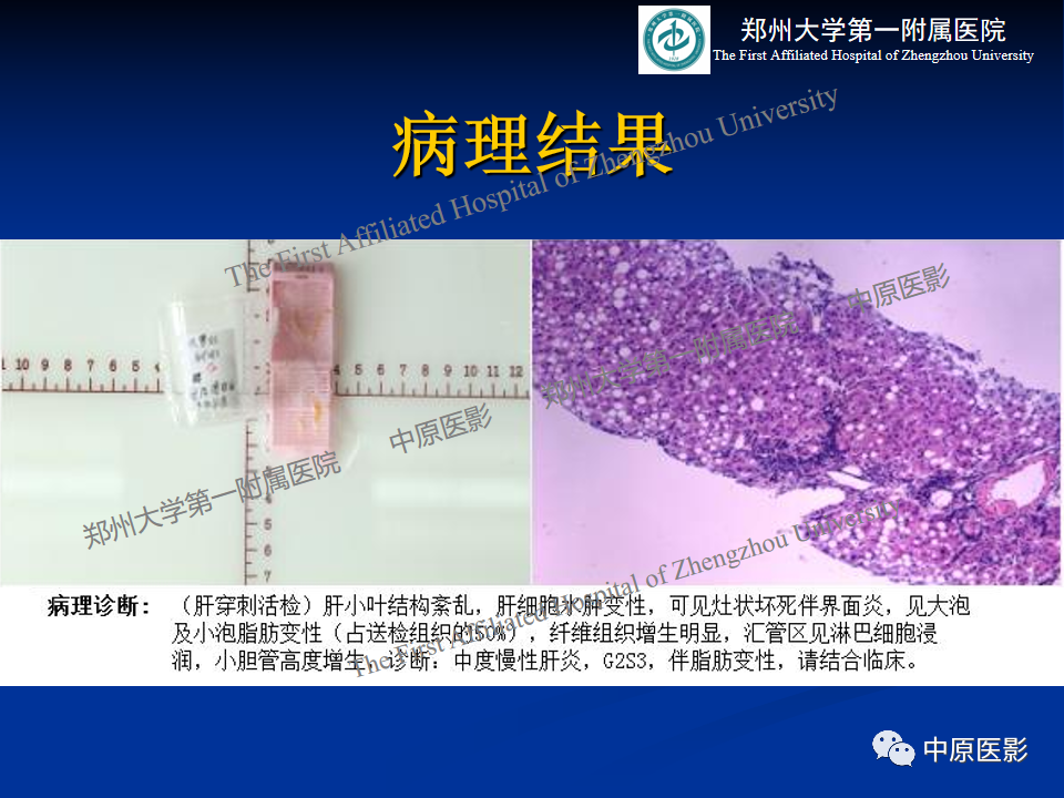 影像PPT - 【病例】肝豆状核变性1例MR影像表现-8