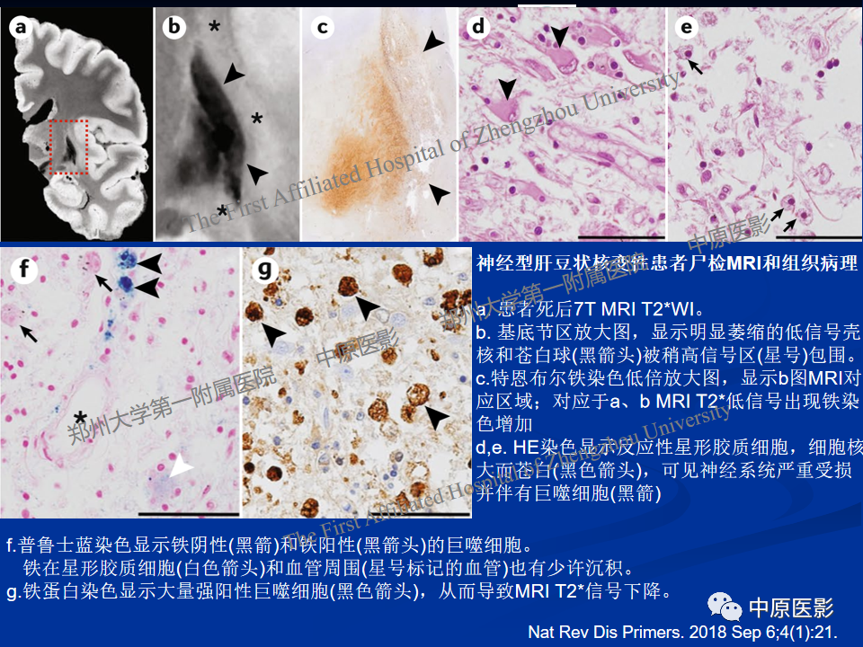 影像PPT - 【病例】肝豆状核变性1例MR影像表现-11