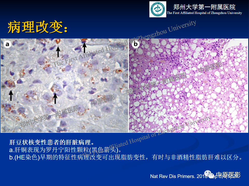 影像PPT - 【病例】肝豆状核变性1例MR影像表现-10