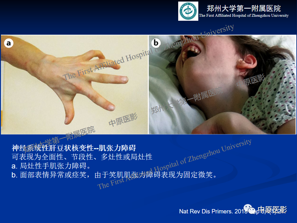 影像PPT - 【病例】肝豆状核变性1例MR影像表现-13