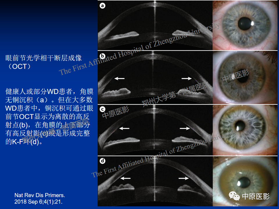 影像PPT - 【病例】肝豆状核变性1例MR影像表现-17