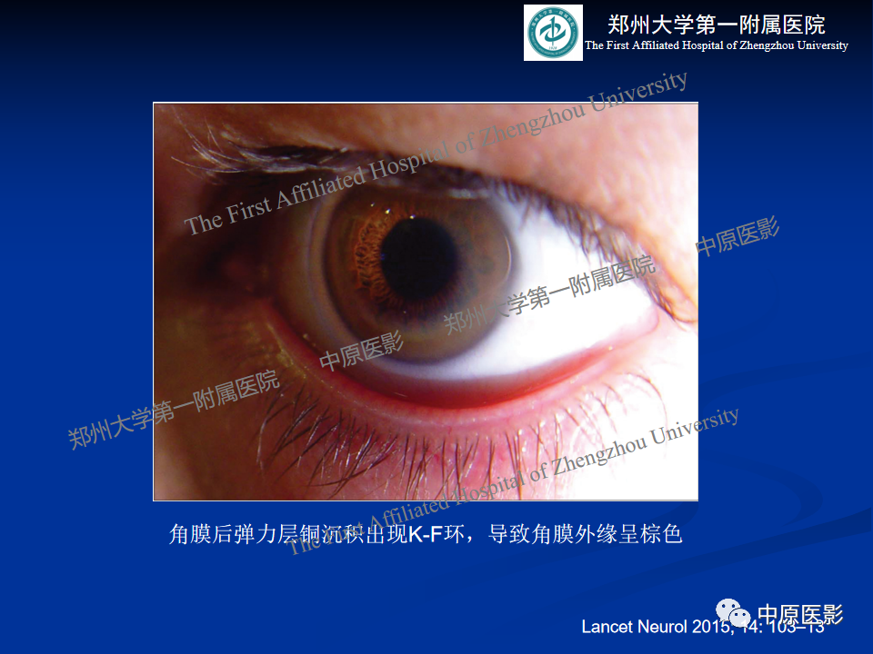 影像PPT - 【病例】肝豆状核变性1例MR影像表现-16