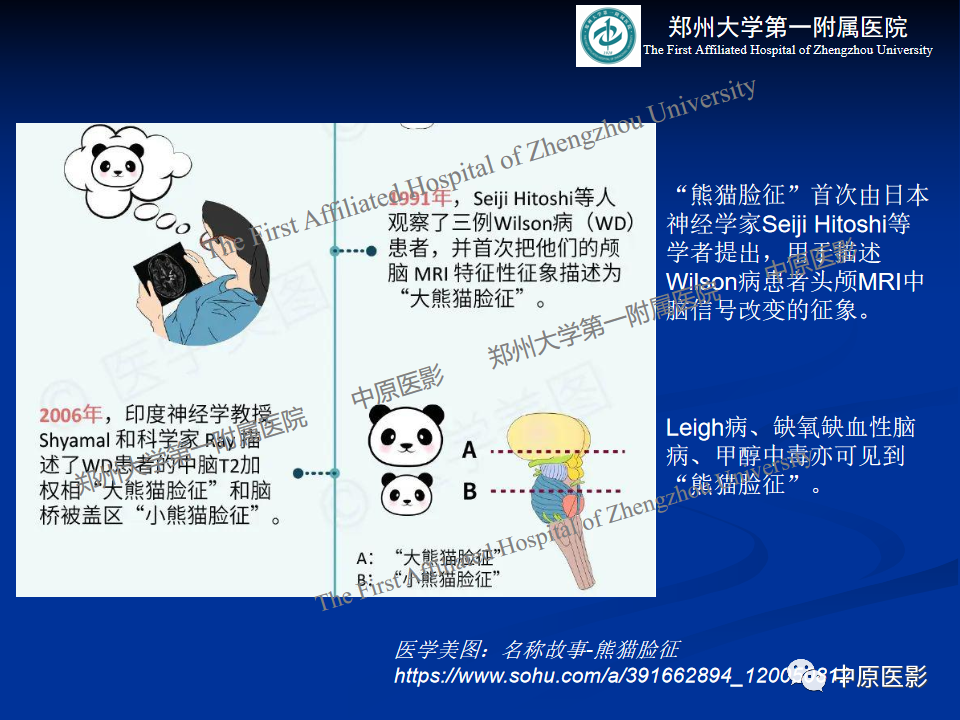影像PPT - 【病例】肝豆状核变性1例MR影像表现-20