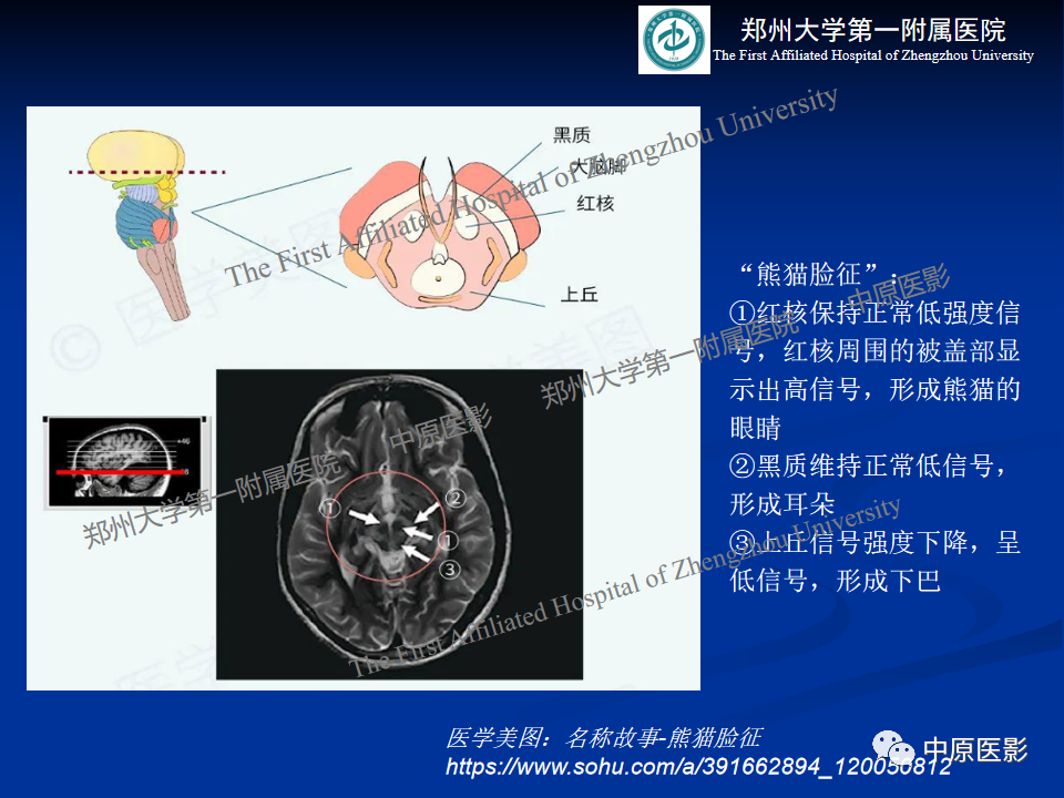 影像PPT - 【病例】肝豆状核变性1例MR影像表现-21
