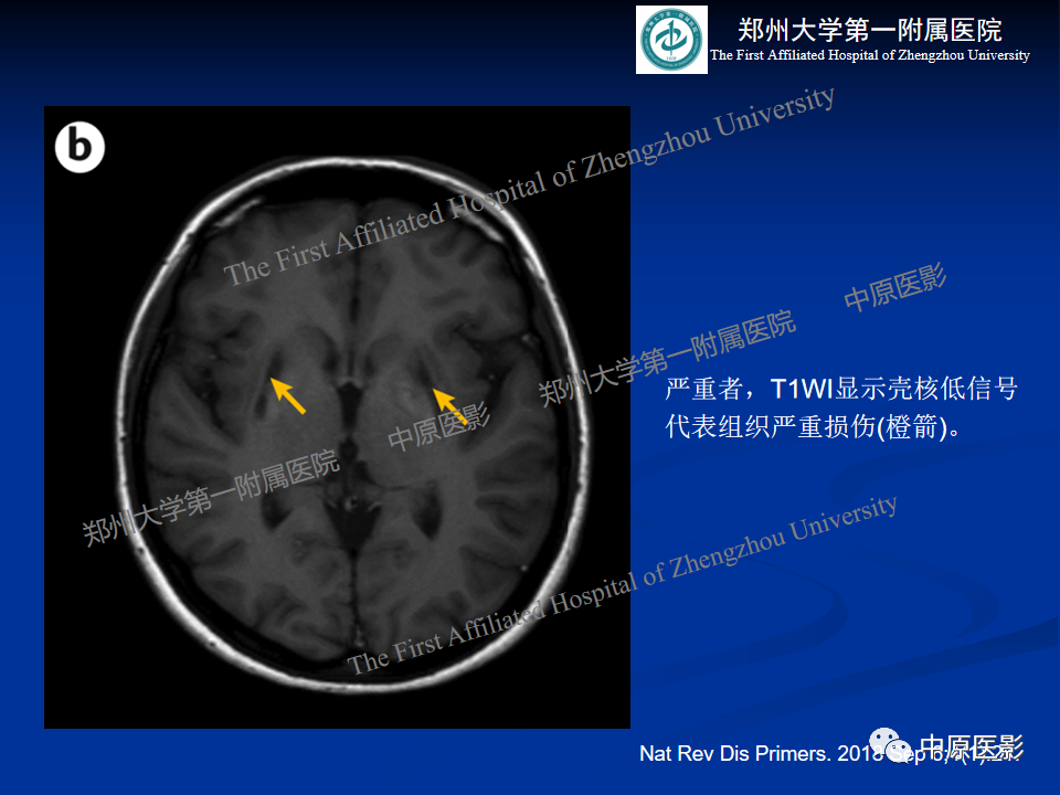 影像PPT - 【病例】肝豆状核变性1例MR影像表现-24