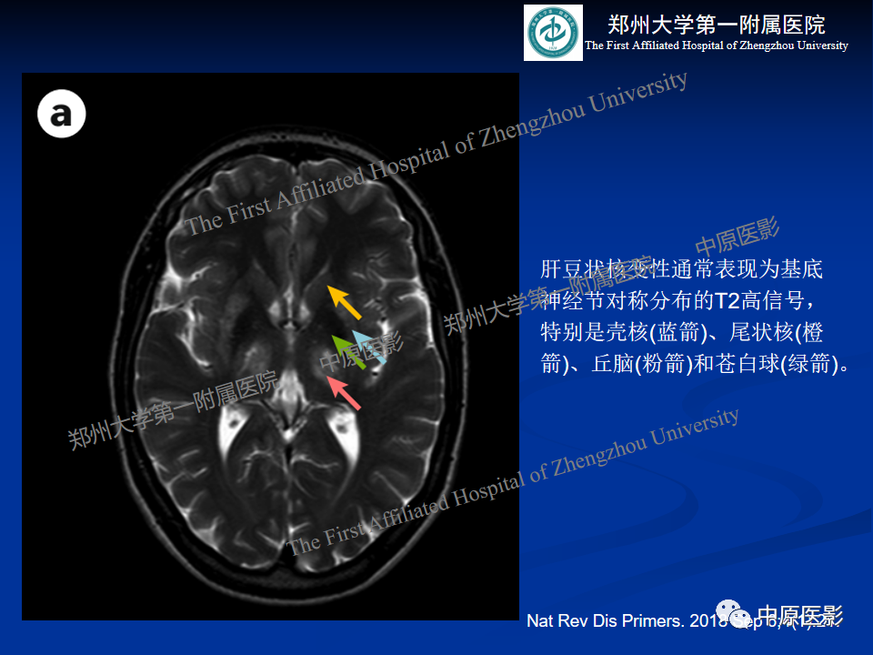影像PPT - 【病例】肝豆状核变性1例MR影像表现-23