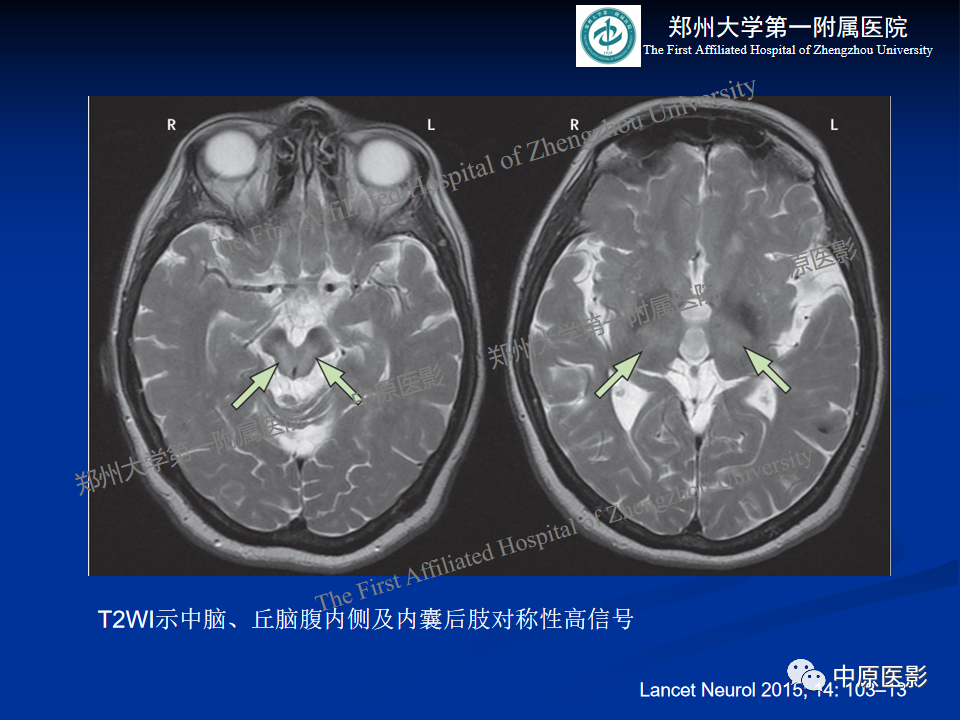 影像PPT - 【病例】肝豆状核变性1例MR影像表现-22