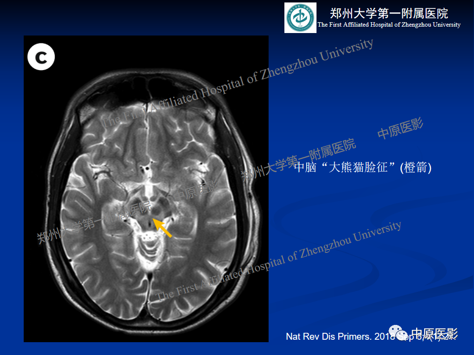 影像PPT - 【病例】肝豆状核变性1例MR影像表现-25