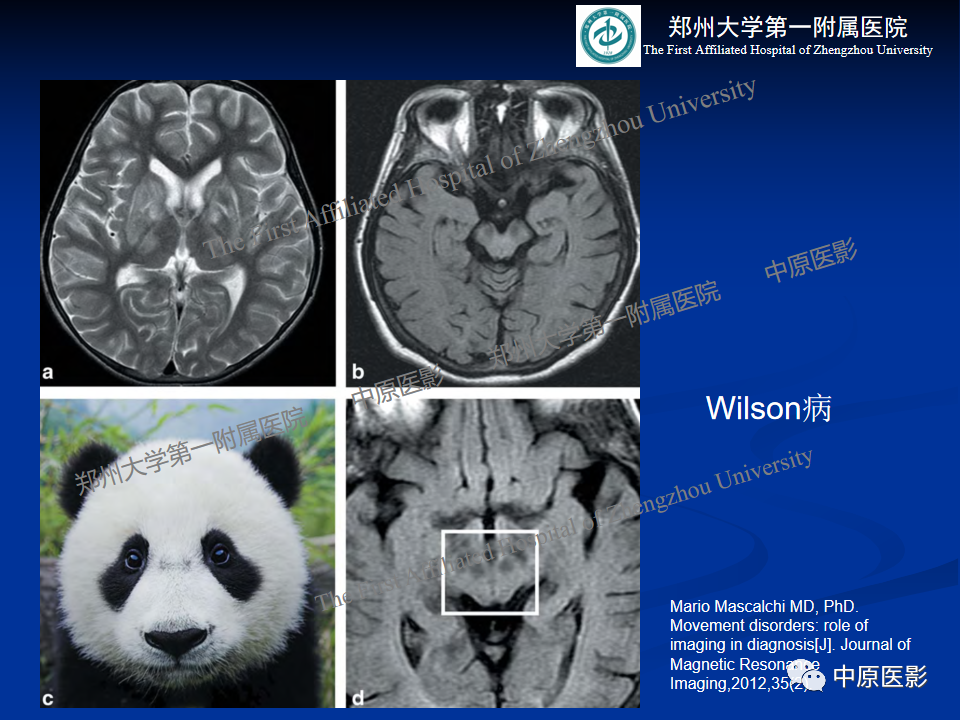 影像PPT - 【病例】肝豆状核变性1例MR影像表现-26