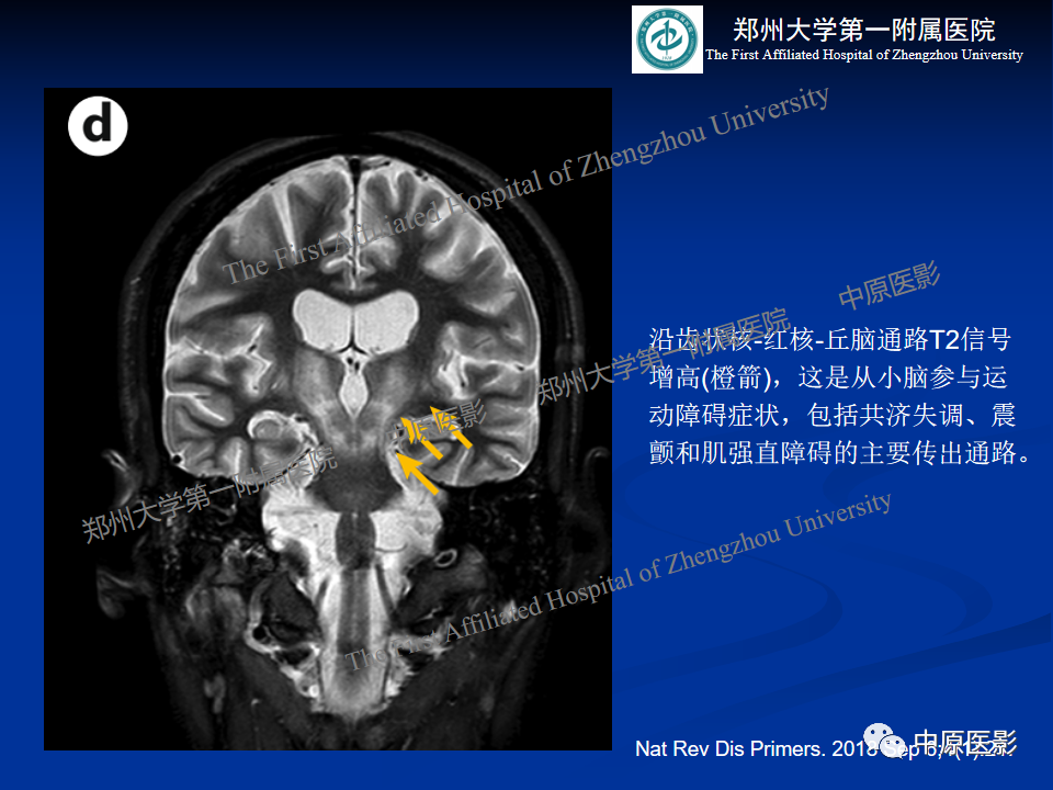 影像PPT - 【病例】肝豆状核变性1例MR影像表现-27