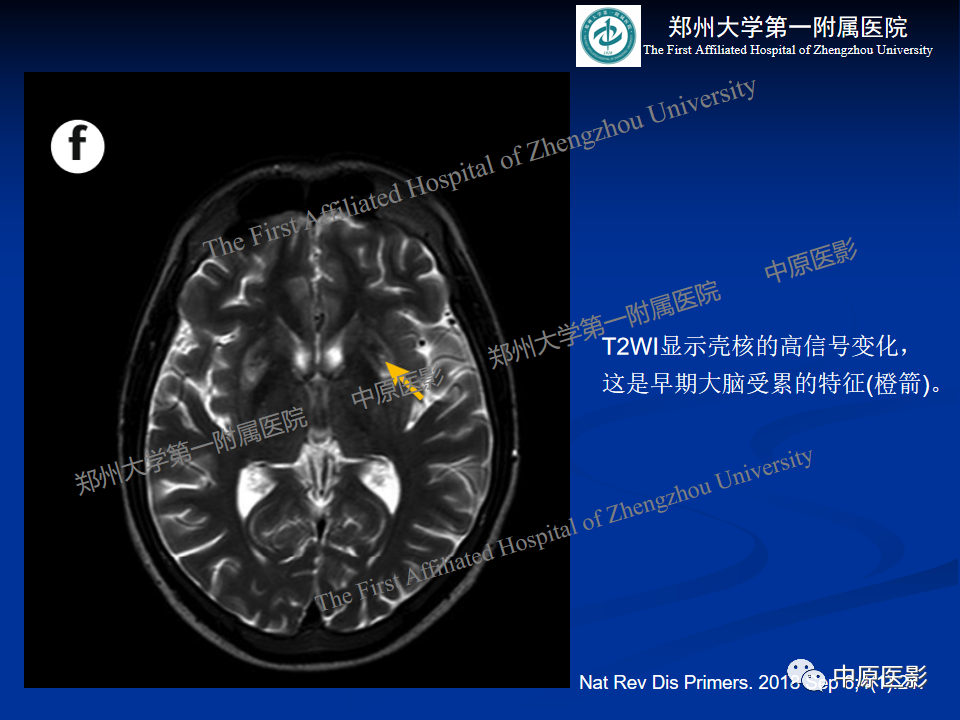影像PPT - 【病例】肝豆状核变性1例MR影像表现-29