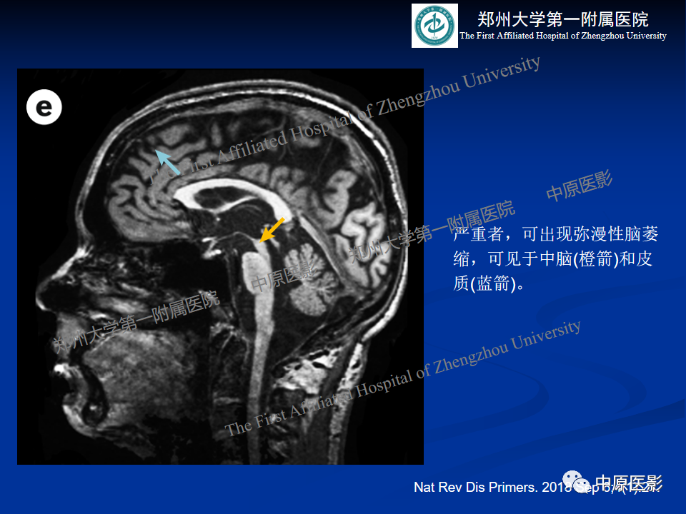 影像PPT - 【病例】肝豆状核变性1例MR影像表现-28