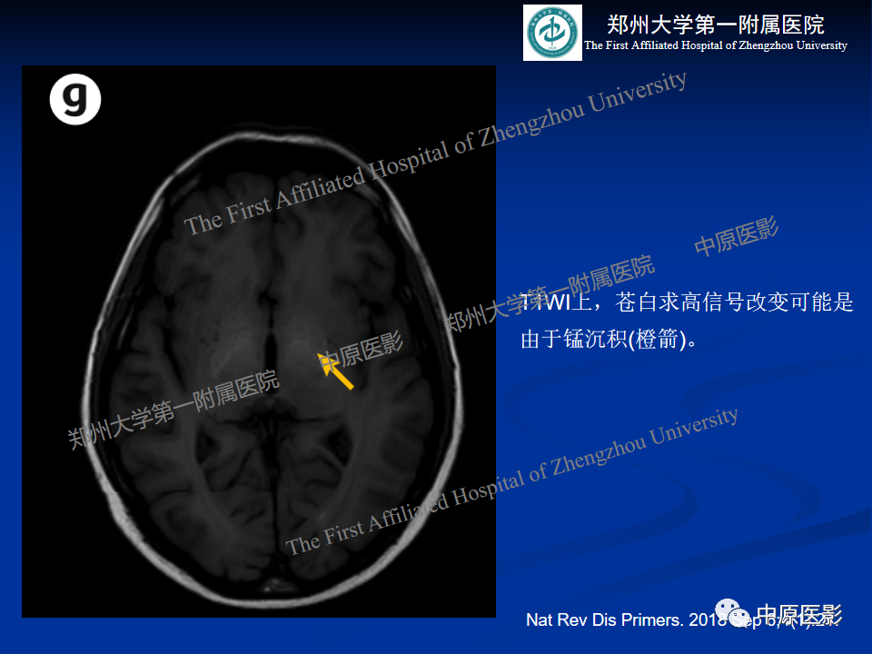 影像PPT - 【病例】肝豆状核变性1例MR影像表现-30