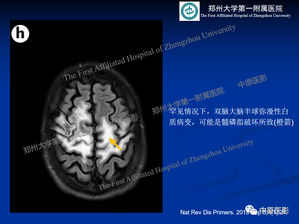 影像PPT - 【病例】肝豆状核变性1例MR影像表现-31
