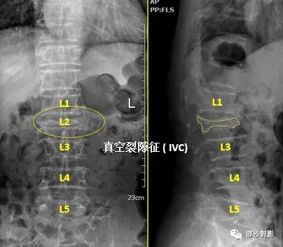 影像PPT - 【病例】Kummell病1例X线MR影像-7 影像PPT - 【病例】Kummell病1例X线MR影像-7