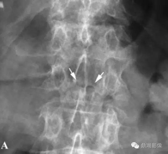 影像PPT - 【病例】Kummell病1例X线MR影像-12 影像PPT - 【病例】Kummell病1例X线MR影像-12