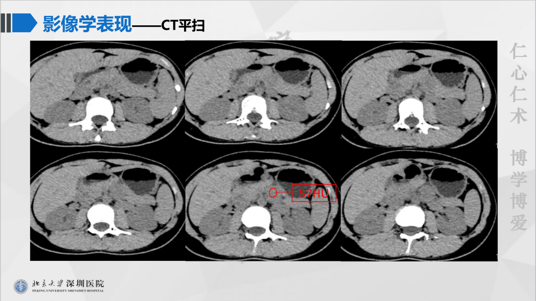 影像PPT - 【PPT】胰腺实性假乳头状瘤-3