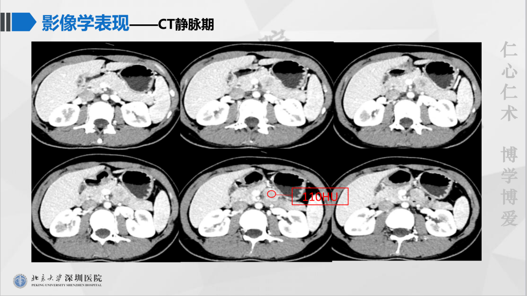 影像PPT - 【PPT】胰腺实性假乳头状瘤-5