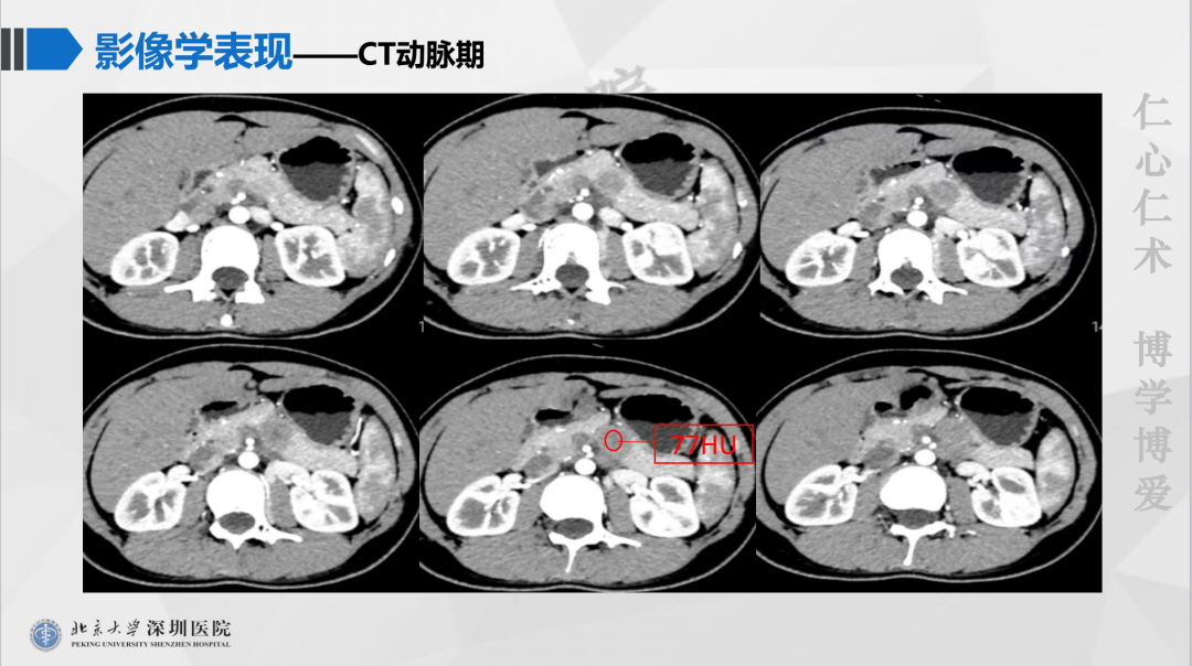 影像PPT - 【PPT】胰腺实性假乳头状瘤-4