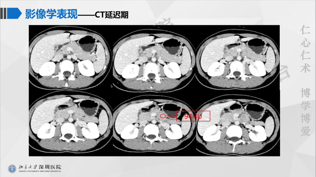 影像PPT - 【PPT】胰腺实性假乳头状瘤-6