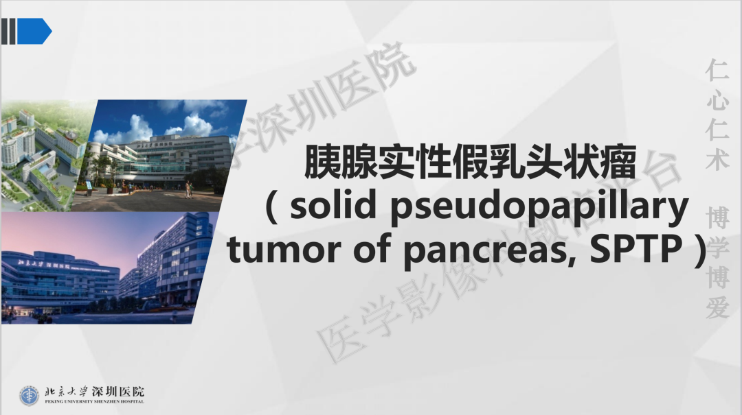 影像PPT - 【PPT】胰腺实性假乳头状瘤-11