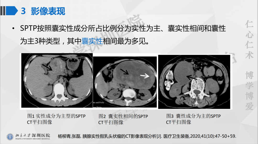 影像PPT - 【PPT】胰腺实性假乳头状瘤-21