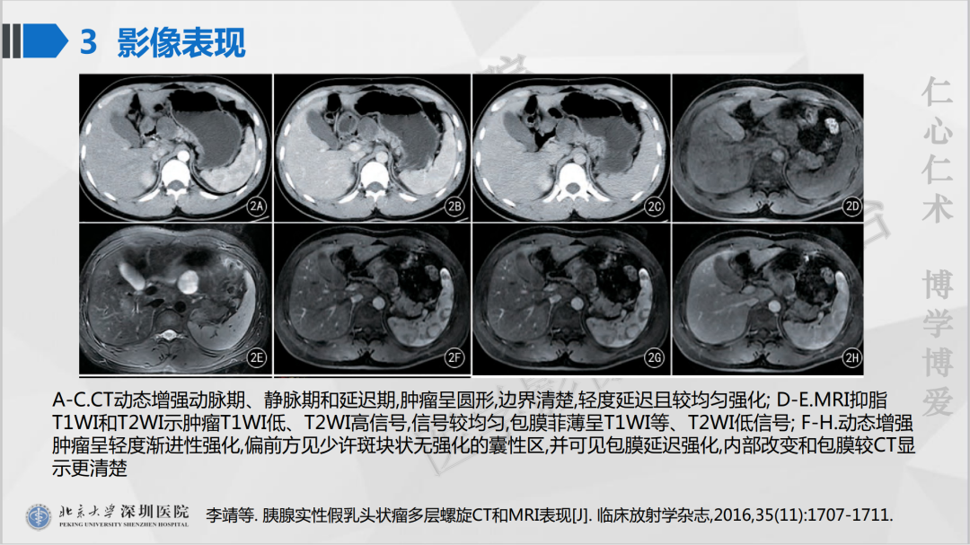 影像PPT - 【PPT】胰腺实性假乳头状瘤-23