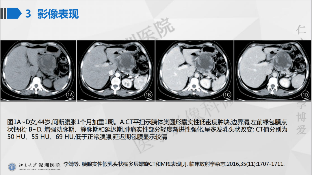 影像PPT - 【PPT】胰腺实性假乳头状瘤-24