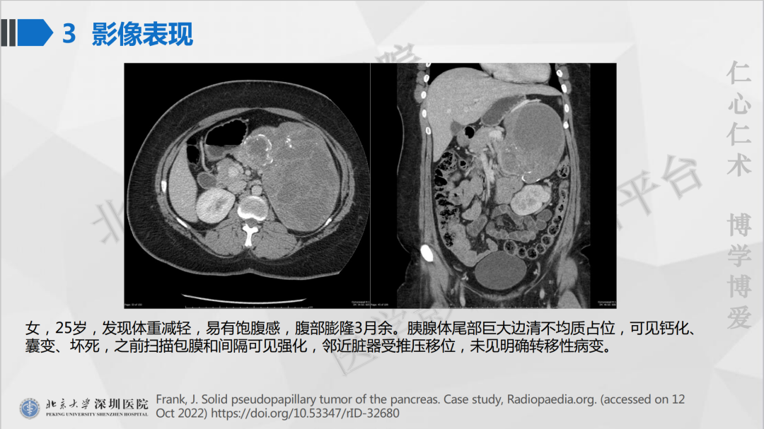 影像PPT - 【PPT】胰腺实性假乳头状瘤-25